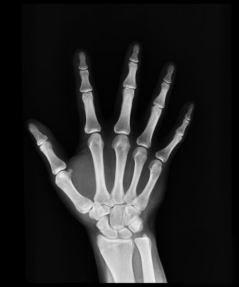 Extremity hand radiograph for occupational and hand therapy